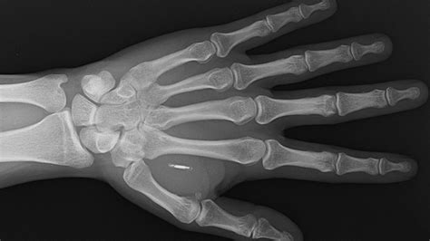 rfid chip in hand or forehead|rfid chip for pets.